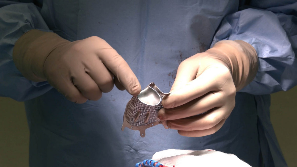 НМИЦ Мешалкина. Индивидуальный заместительный имплантат учитывает все анатомические особенности.jpg НМИЦ Мешалкина. Индивидуальный заместительный имплантат учитывает все анатомические особенности.jpg